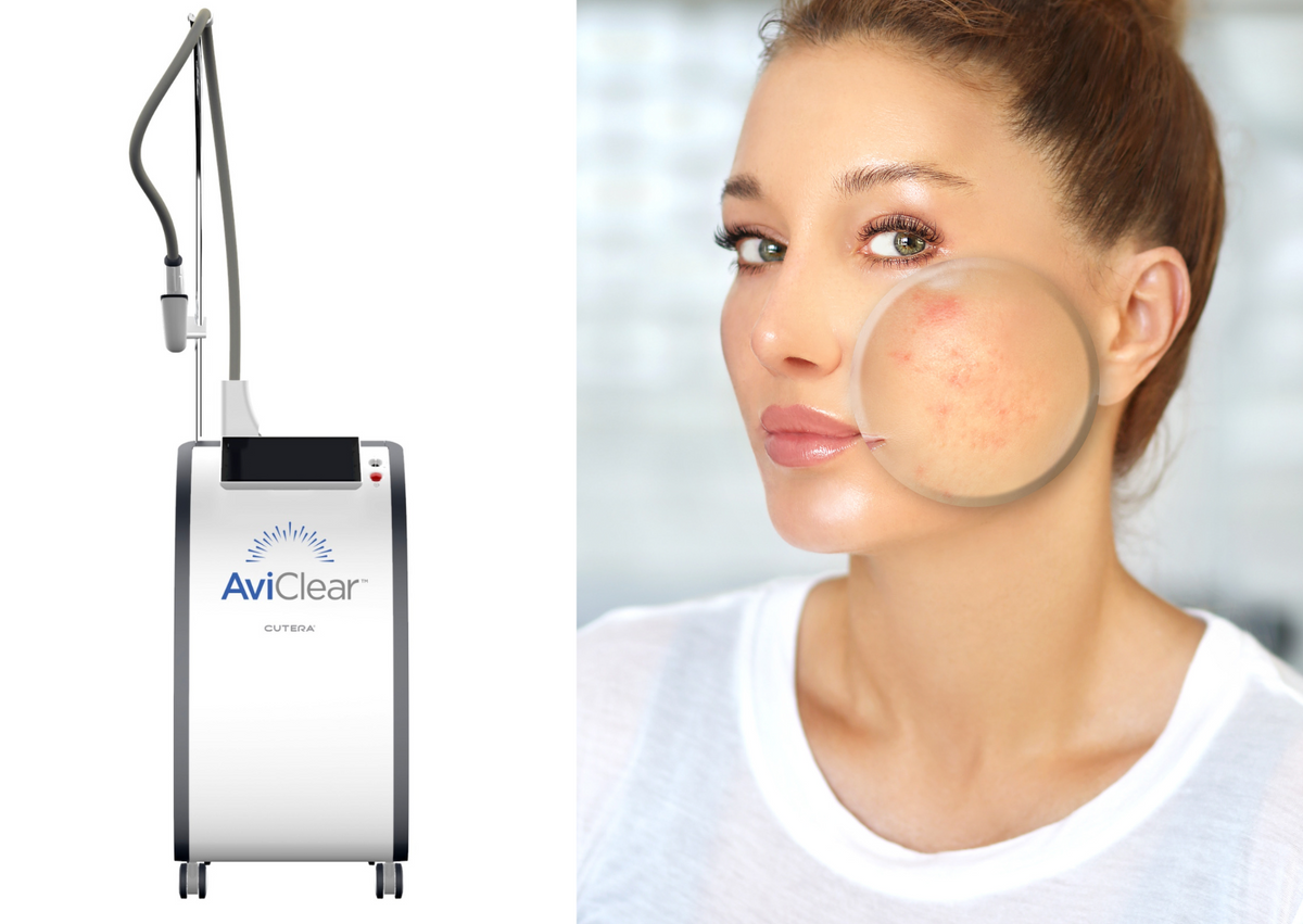 AviClear Treatment Package – Sanctuary Cosmetic Center Aviclear near me