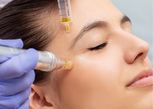 Vampire Facial Treatment - Microneedling with PRP